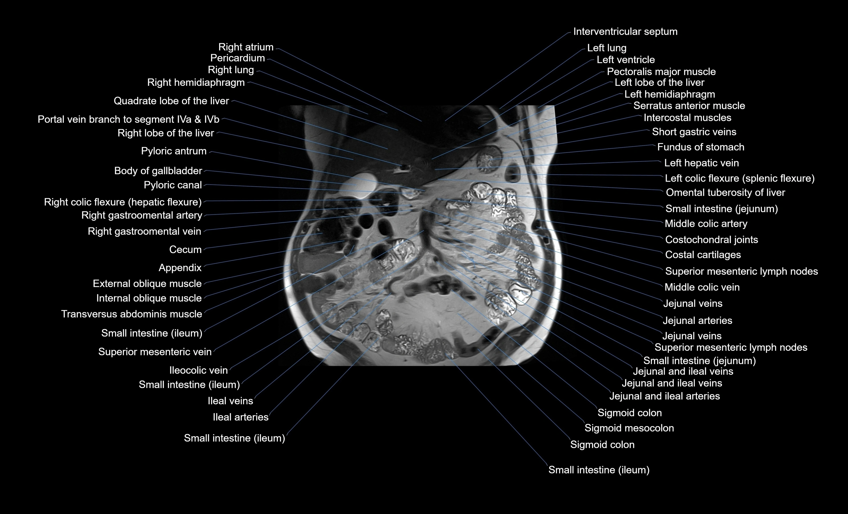 MRI Abdomen coronal labelled cross sectional anatomy radiology  image-img-00001-00022.webp